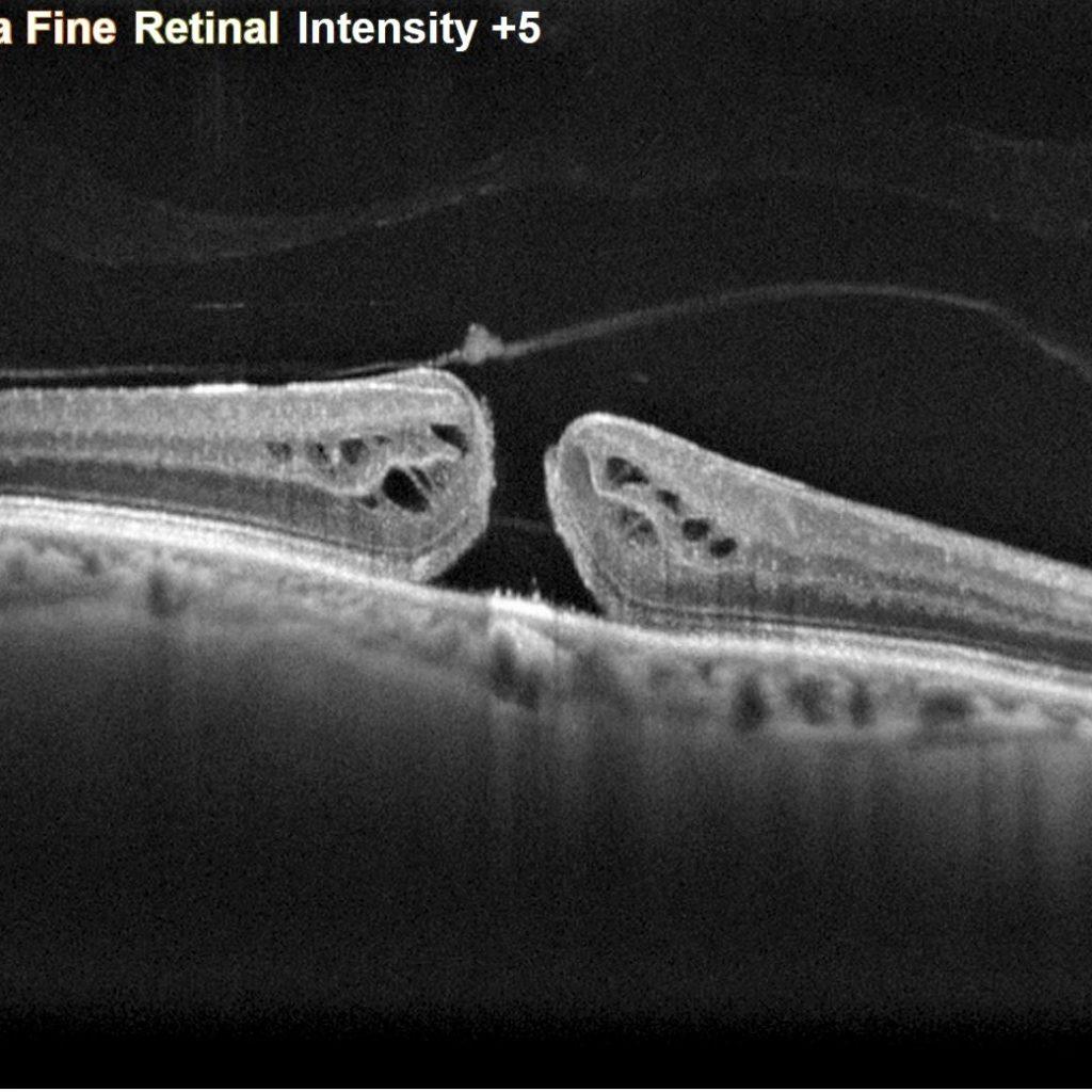 L Oct Angiographie Imagerie D Taill E De La R Tine Nidek France